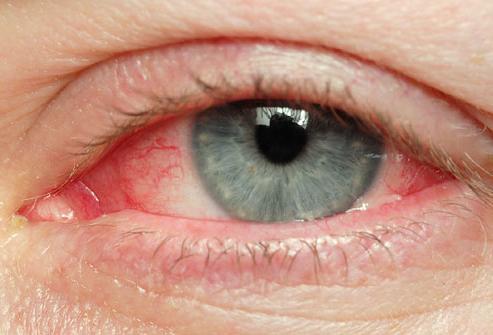 Почему глаза красные и как устранить дискомфорт