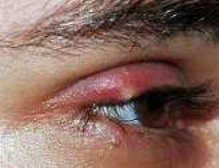 Ячмень на глазу – лечение и профилактика